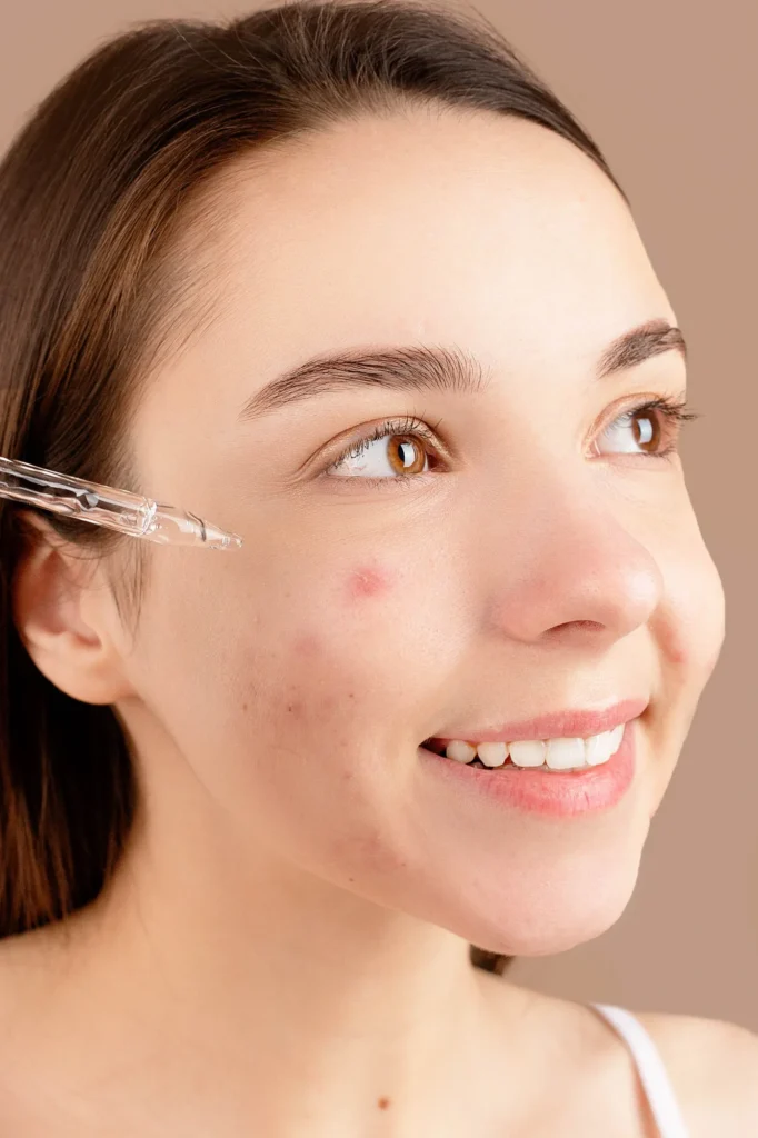 Akneye eğilimli cilde serum uygulayan genç kadın